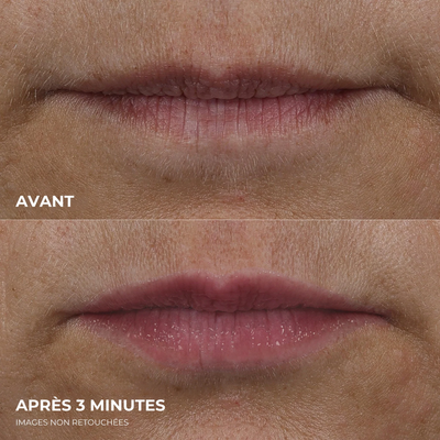 éline™ - Repulpeur de Lèvres