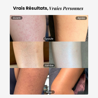 Éline™ - Crème Anti-Kératose